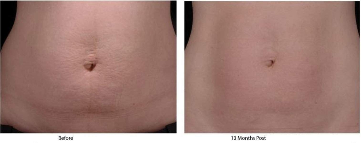 Palmer's Cocoa Butter Formula With Vitamin E Skin Therapy Oil 150ml/ 5.1 Fl. Oz.