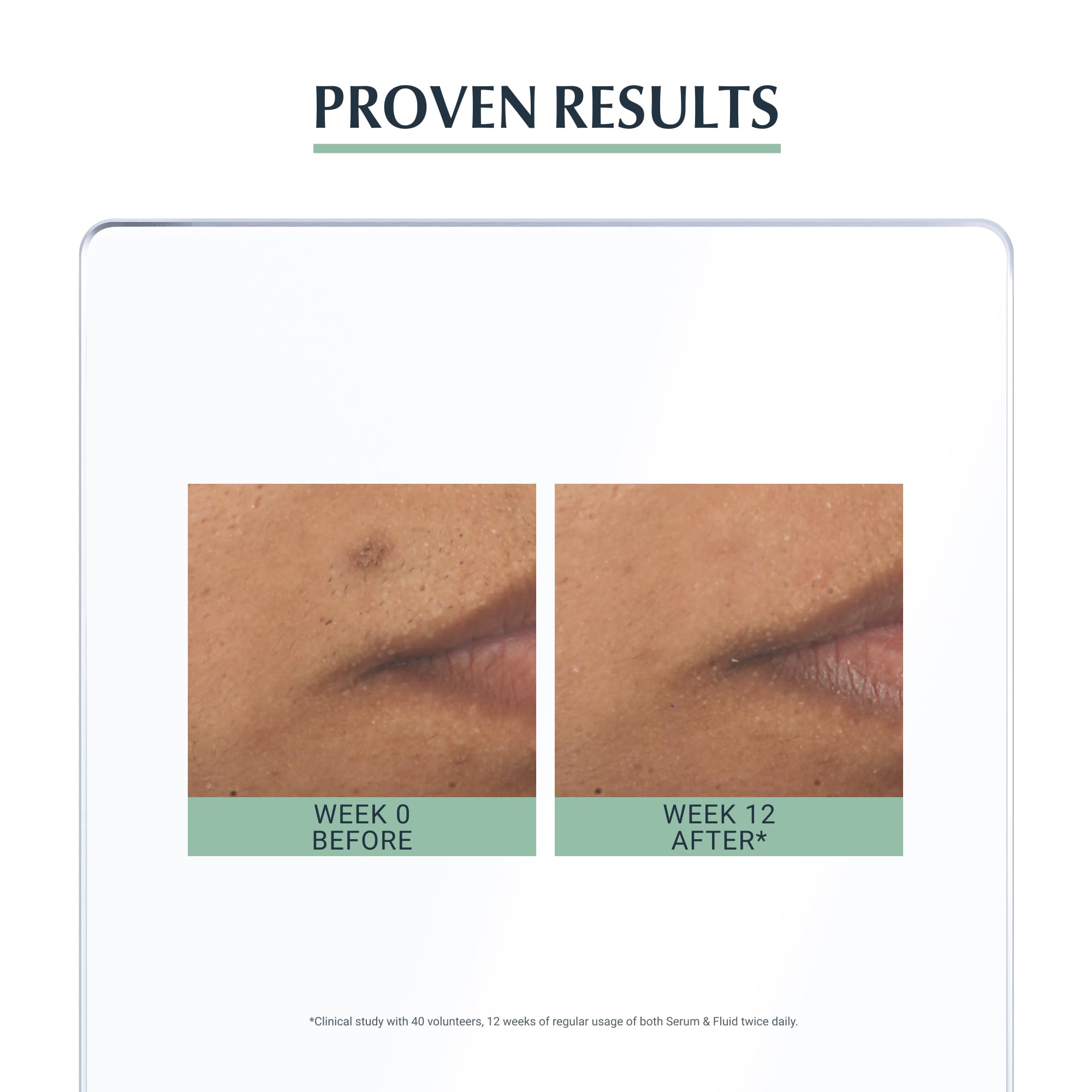 Eucerin DermoPurifyer Triple Effect Serum 40ml, Post Acne Treatment for Blemish-Prone Skincare, Reduces Hyperpigmentation Spots, Controls Shine and Prevents New Blemishes, with Salicylic Acid